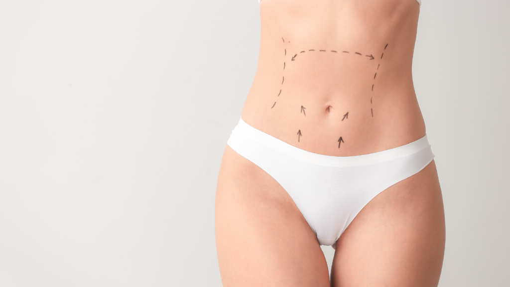 tummy tuck mommy makeover image